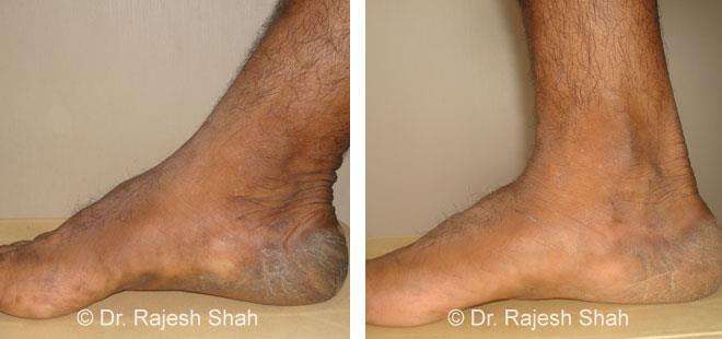 Psoriasis Before and After Case Photo