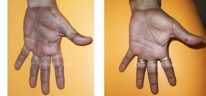 Psoriasis Before and After Case Photo