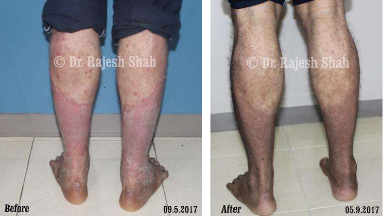 Psoriasis Before and After Case Photo