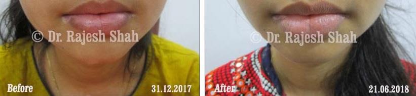 Vitiligo Before and After Case Photo