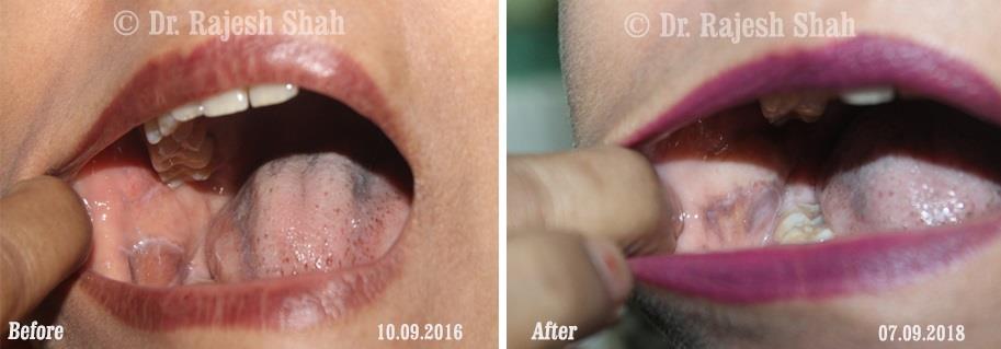 Lichen Planus Before and After Case Photo