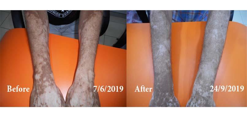 Vitiligo Before and After Case Photo