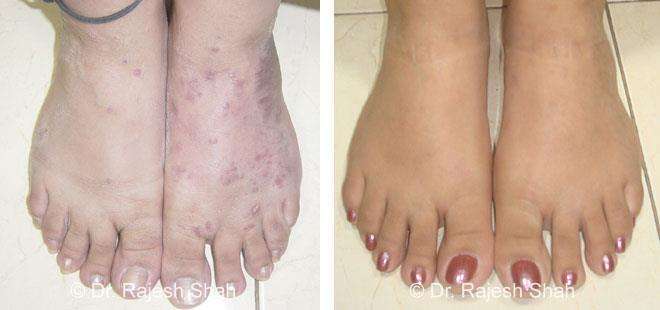Lichen Planus Before and After Case Photo