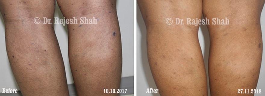 Lichen Planus Before and After Case Photo