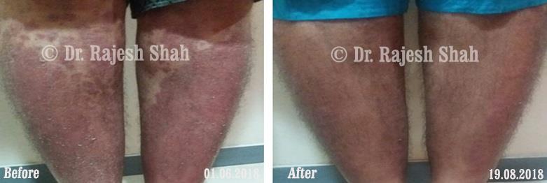 Psoriasis Before and After Case Photo