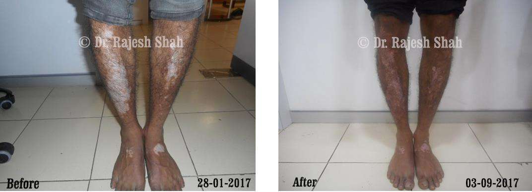 Vitiligo Before and After Case Photo