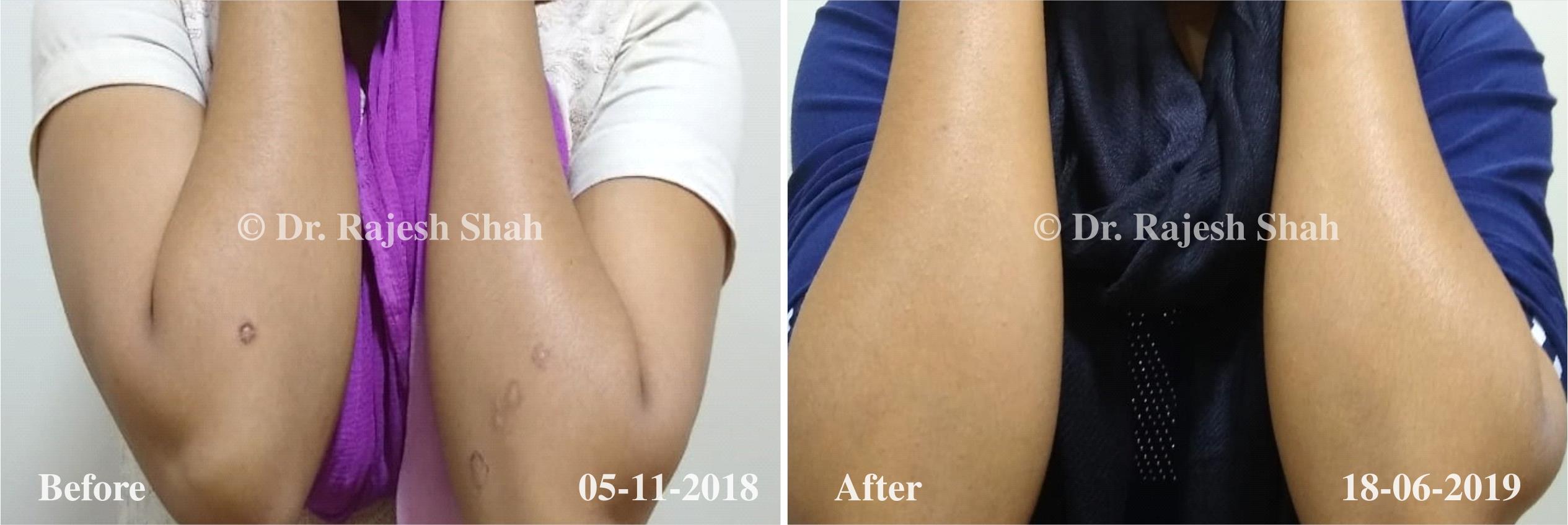 Psoriasis Before and After Case Photo