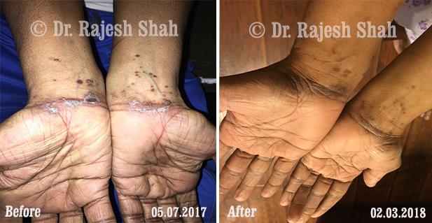 Lichen Planus Before and After Case Photo