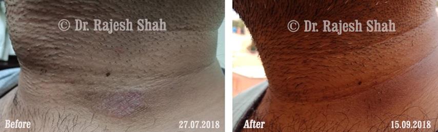 Psoriasis Before and After Case Photo