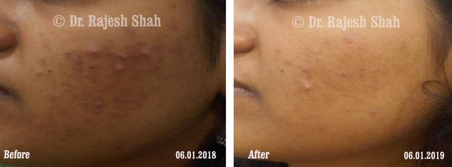 Acne Before and After Case Photo