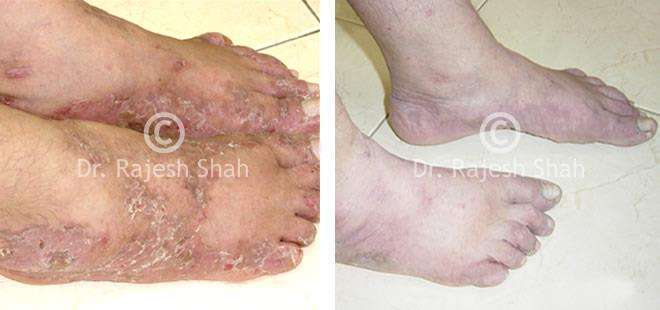 Psoriasis Before and After Case Photo