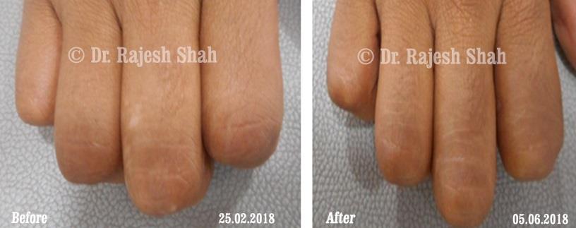 Vitiligo Before and After Case Photo