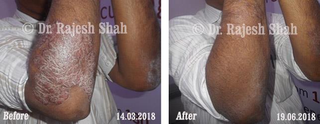 Psoriasis Before and After Case Photo