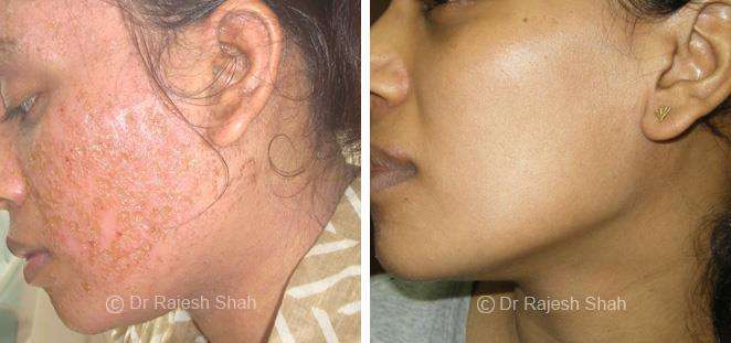 Eczema Before and After Case Photo