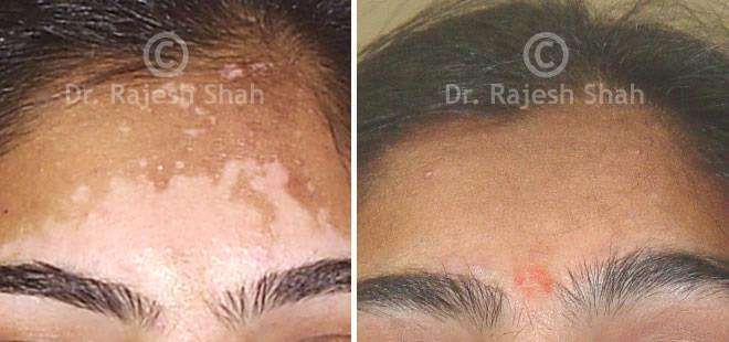 Vitiligo Before and After Case Photo