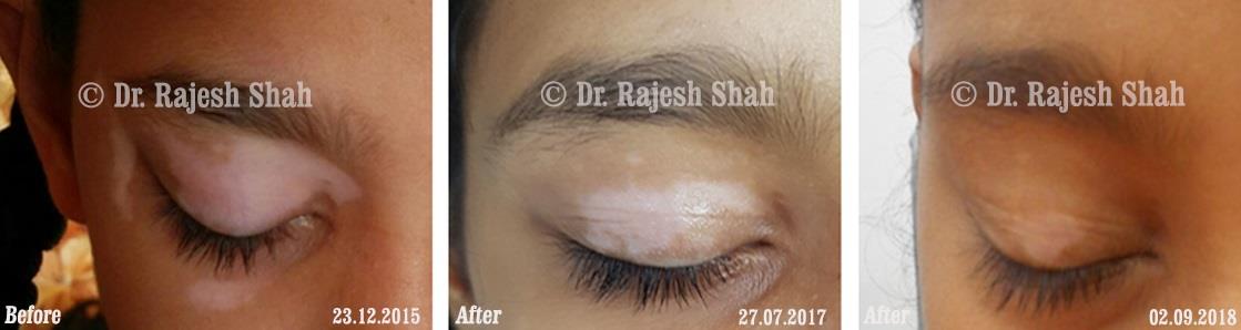 Vitiligo Before and After Case Photo