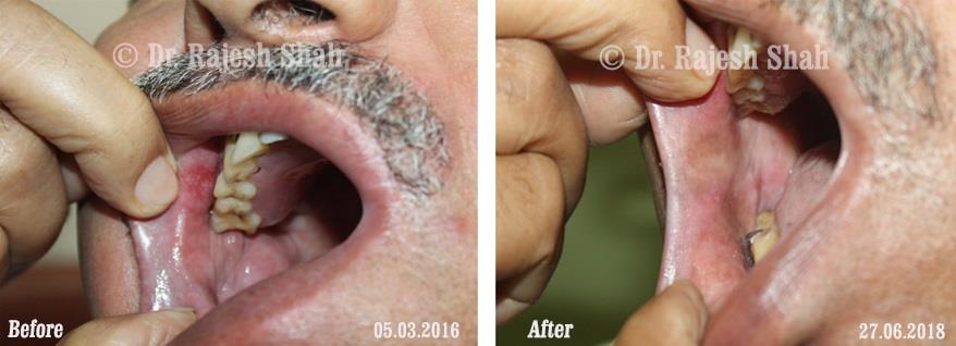 Lichen Planus Before and After Case Photo