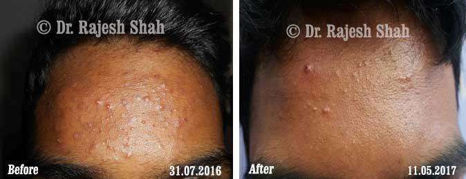 Acne Before and After Case Photo