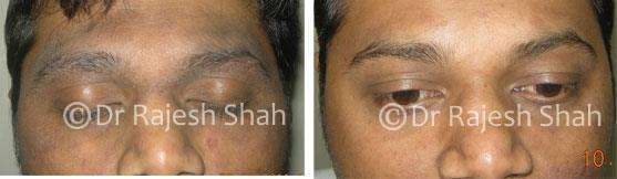 Eczema Before and After Case Photo