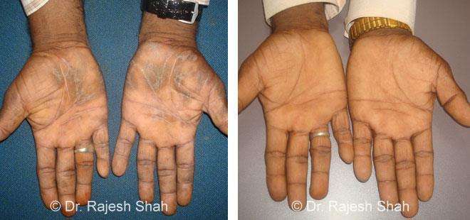 Psoriasis Before and After Case Photo