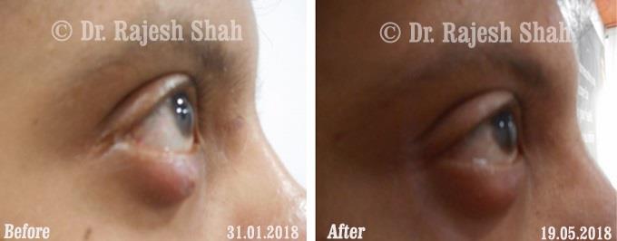 Chalazion Before and After Case Photo