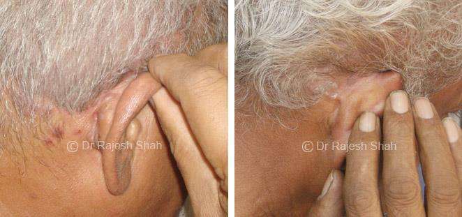 Psoriasis Before and After Case Photo