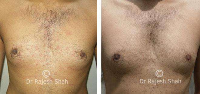 Lichen Planus Before and After Case Photo