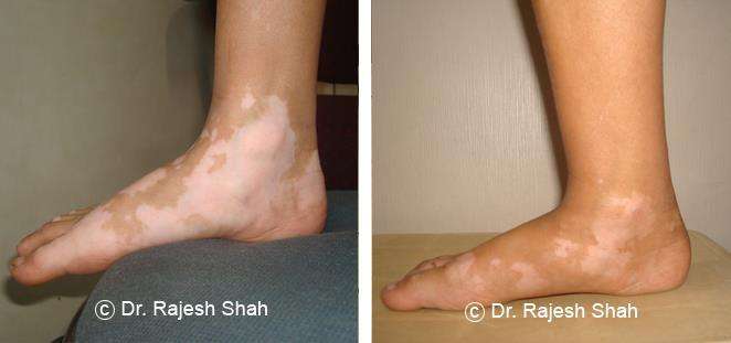 Vitiligo Before and After Case Photo