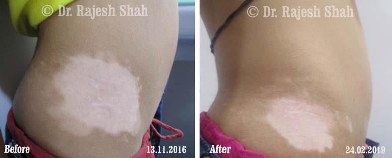 Vitiligo Before and After Case Photo