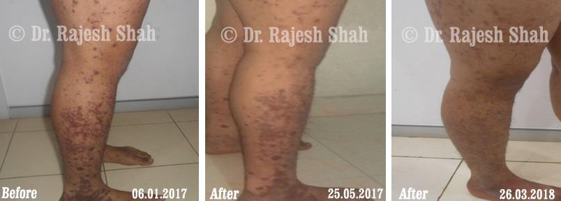 Lichen Planus Before and After Case Photo