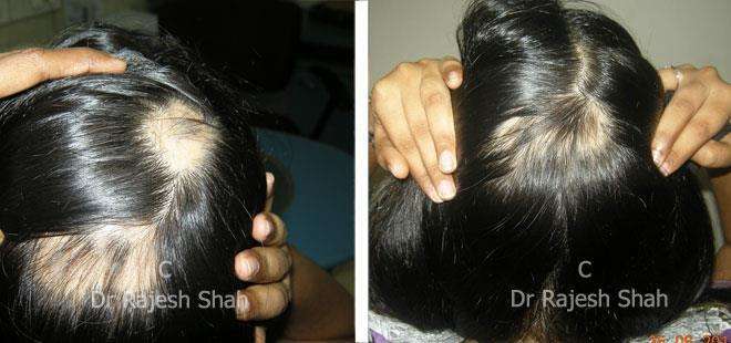 Alopecia Areata Before and After Case Photo