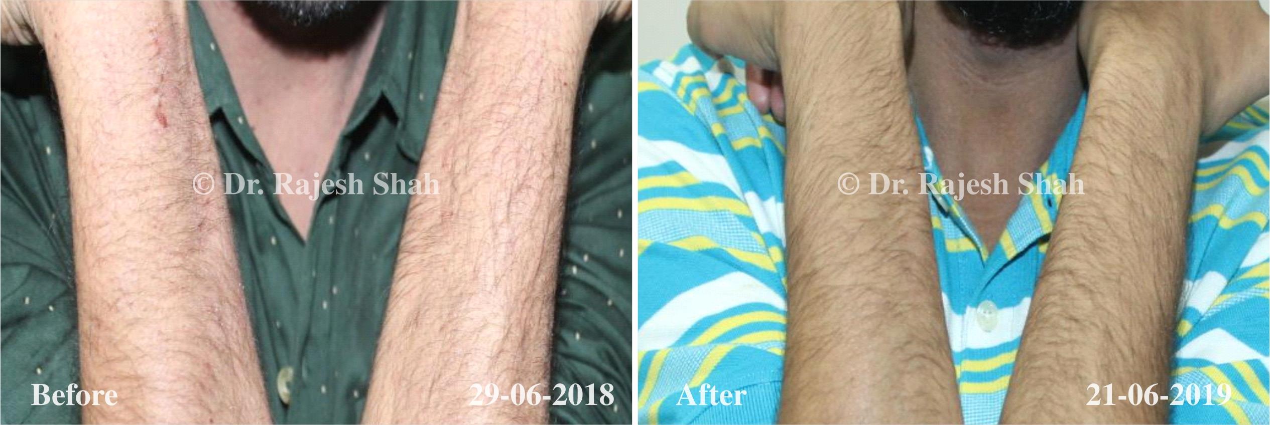 Atopic Dermatitis Before and After Case Photo