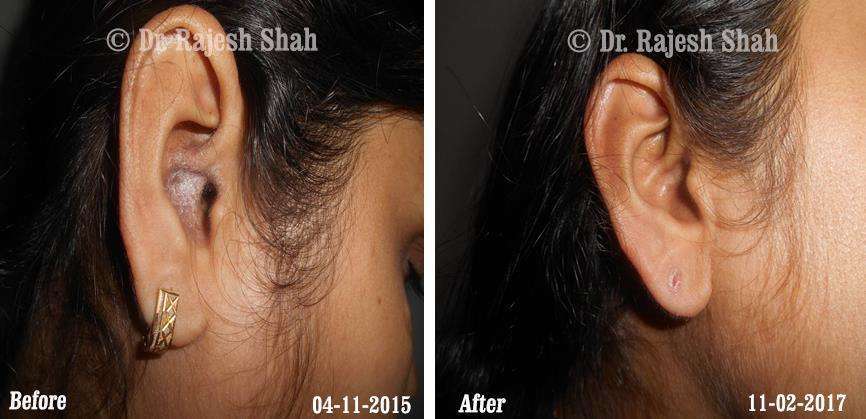 Psoriasis Before and After Case Photo