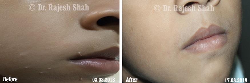 Molluscum contagiosum Before and After Case Photo