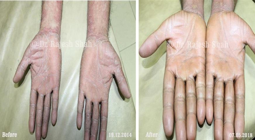 Psoriasis Before and After Case Photo