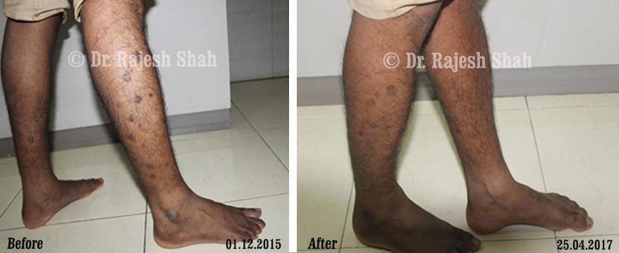 Lichen Planus Before and After Case Photo