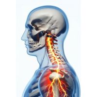 Cervical Radiculopathy