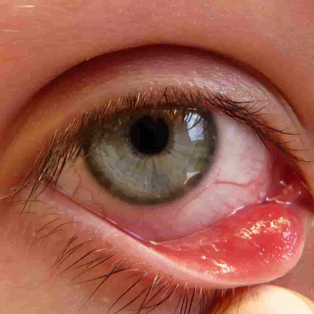 Chalazion