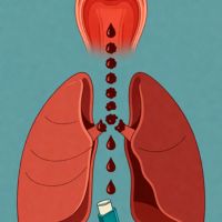 Cough-Variant Asthma (CVA)