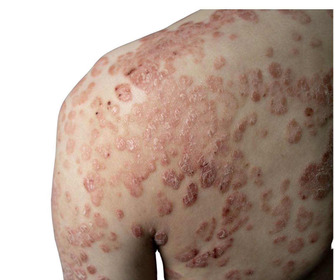 Guttate psoriasis