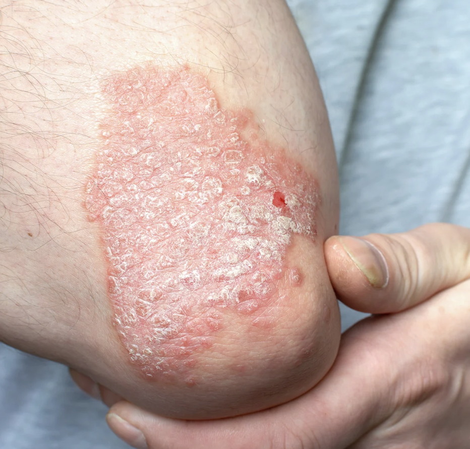 Inverse psoriasis