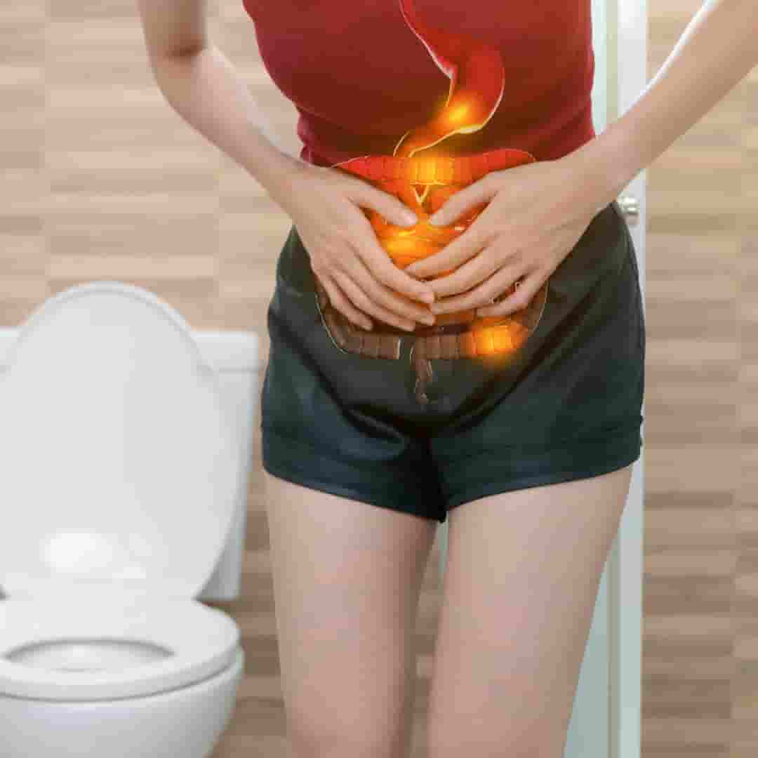 Irritable Bowel Syndrome
