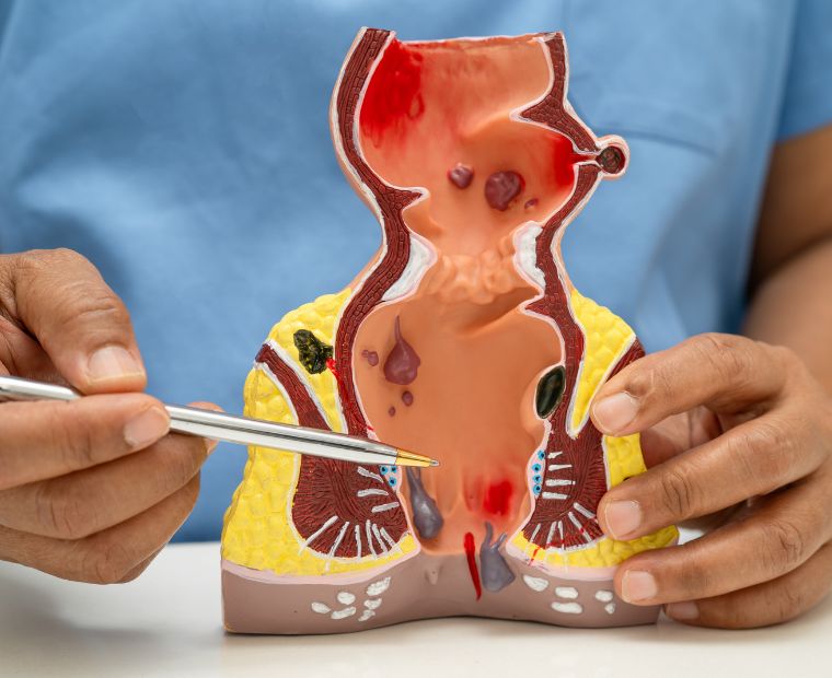 Our Experience in Fissure in ano