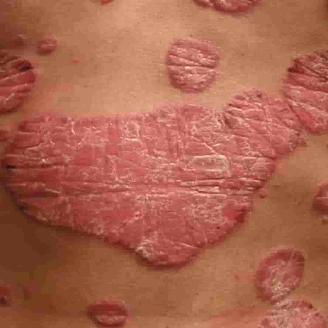 Psoriasis