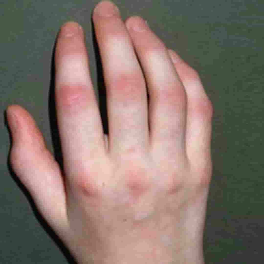 Psoriatic Arthritis