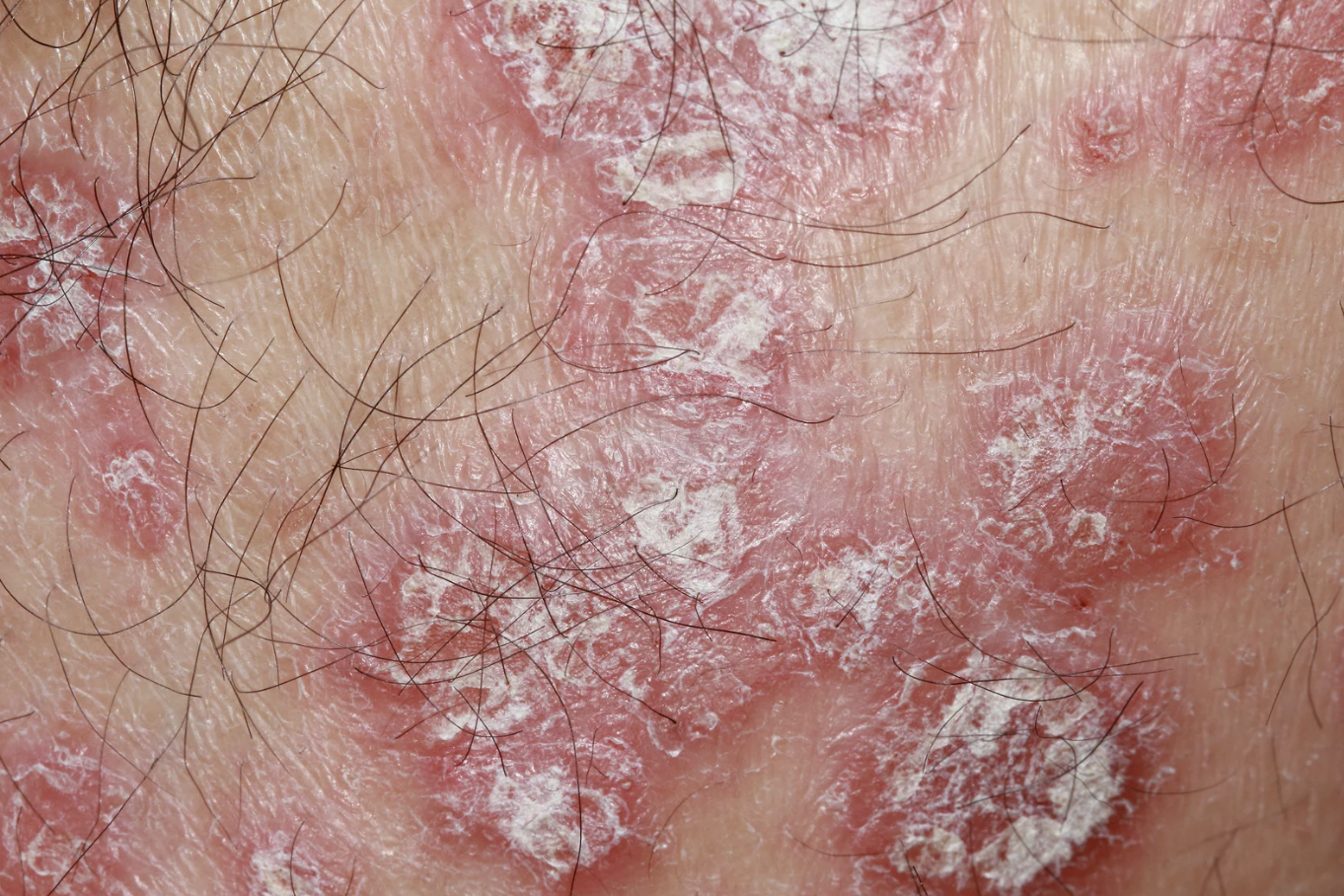 Pustular psoriasis