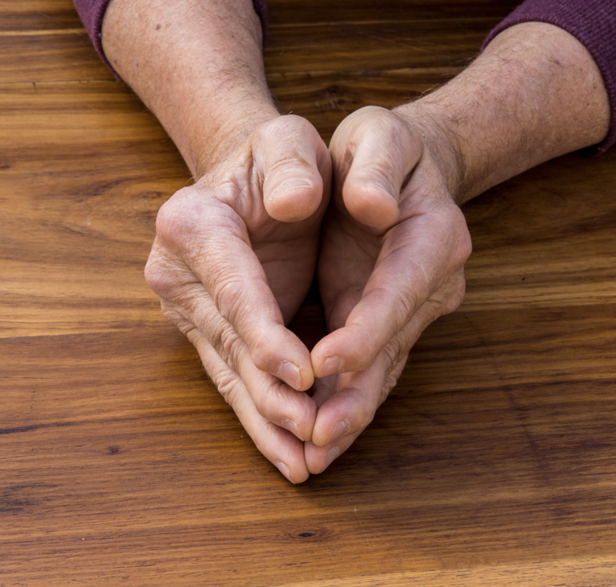 Symmetrical Psoriatic arthritis