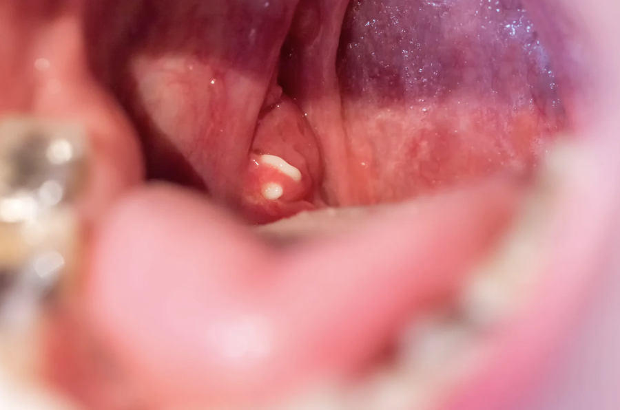 Tonsil abscess