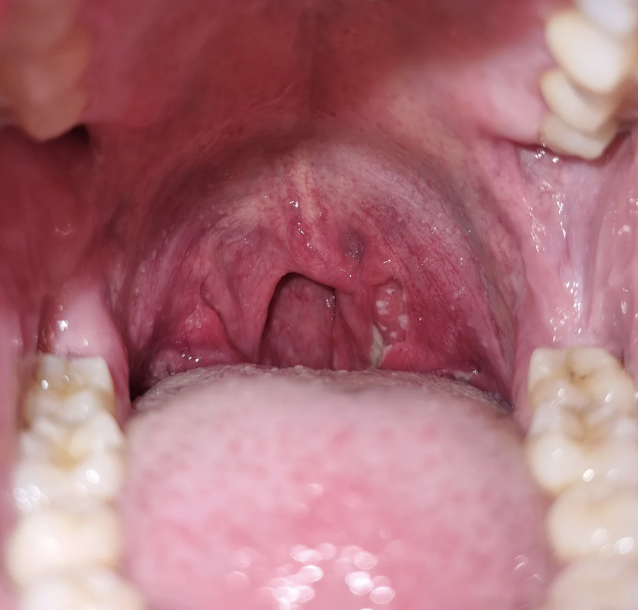 Acute tonsillitis
