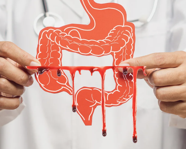 Symptoms of Ulcerative colitis